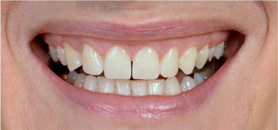 Dentprevent Veneers