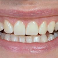 Dentprevent Veneers