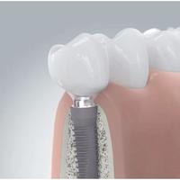 Dentprevent Zahnimplantate 2