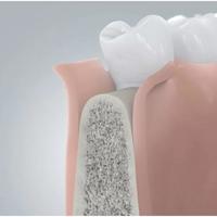 Dentprevent Implantologie