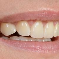 Dentprevent Veeners