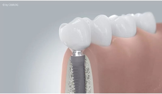 Dentprevent Zahnimplantate 2
